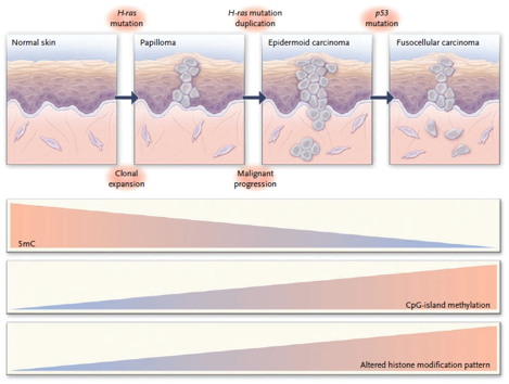 A multistage model of carcinogenesis in skin is shown. In conjunction with phenotypic cellular changes and the accumulation of genetic defects, there is a progressive loss of total DNA methylation content, an increased frequency of hypermethylated CpG islands, and an increased histone-modification imbalance in the development of the disease. H-ras denotes Harvey–ras oncogene, and 5mC 5-methylcytosine. Source: N Engl J Med 2008;358:1148-59. Copyright © 2008 Massachusetts Medical Society